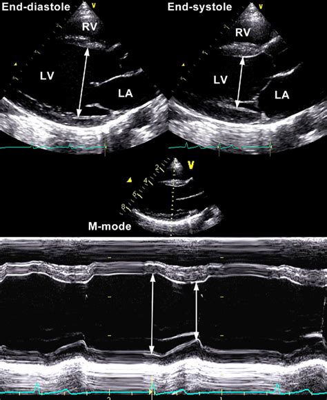 Left Ventricular End.